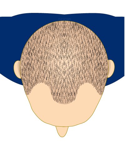 Haartransplantaties afbeelding